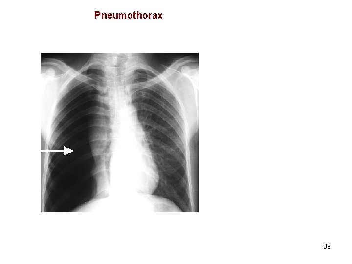 Pneumothorax 39 