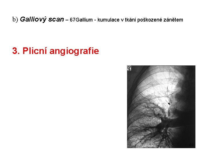 b) Galliový scan – 67 Gallium - kumulace v tkáni poškozené zánětem 3. Plicní