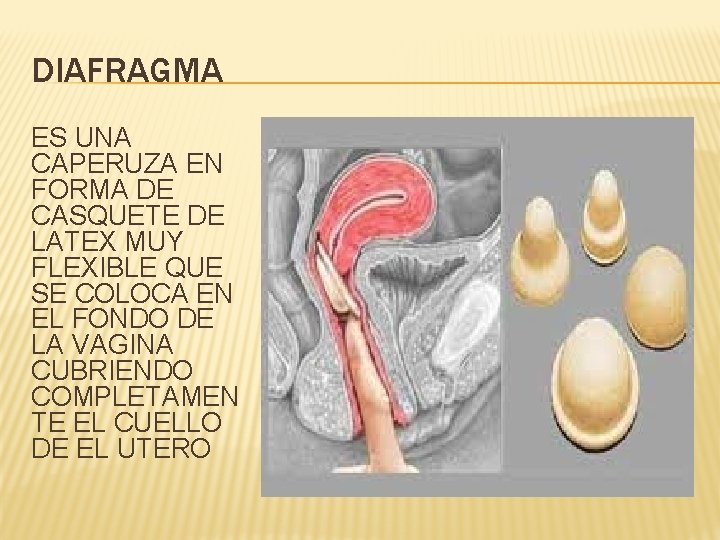 DIAFRAGMA ES UNA CAPERUZA EN FORMA DE CASQUETE DE LATEX MUY FLEXIBLE QUE SE