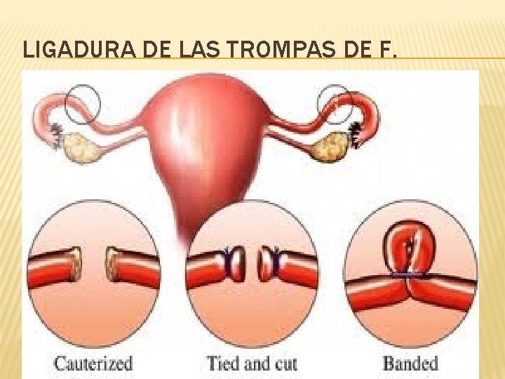 LIGADURA DE LAS TROMPAS DE F. 