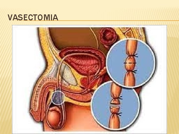 VASECTOMIA 