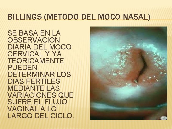 BILLINGS (METODO DEL MOCO NASAL) SE BASA EN LA OBSERVACION DIARIA DEL MOCO CERVICAL