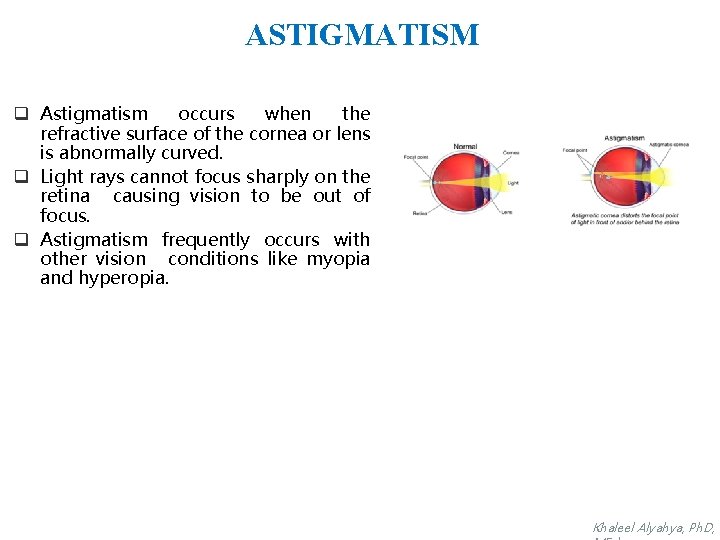 ASTIGMATISM q Astigmatism occurs when the refractive surface of the cornea or lens is