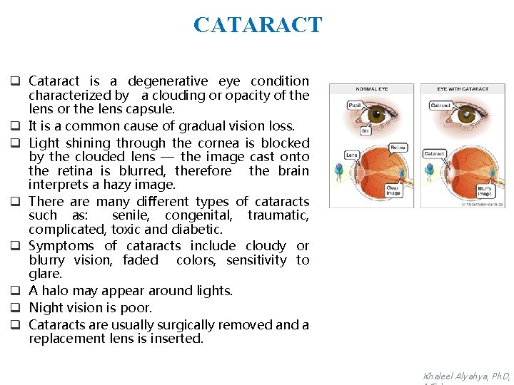 CATARACT q Cataract is a degenerative eye condition characterized by a clouding or opacity