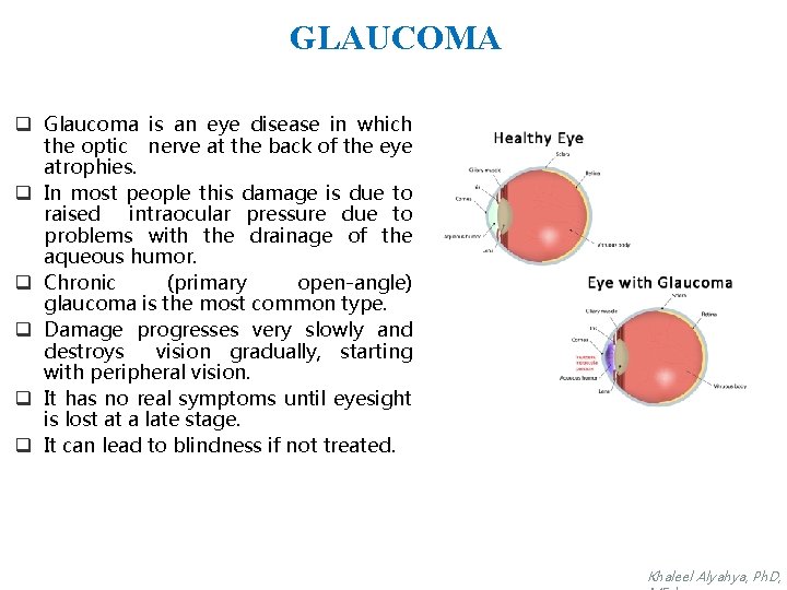 GLAUCOMA q Glaucoma is an eye disease in which the optic nerve at the