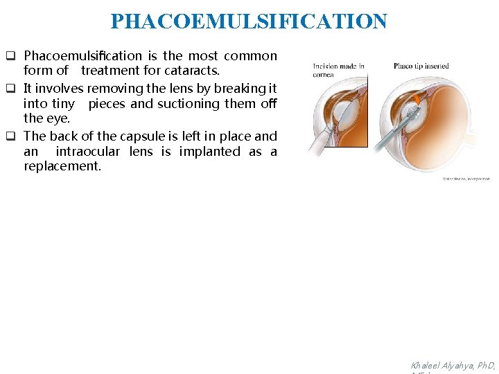 PHACOEMULSIFICATION q Phacoemulsiﬁcation is the most common form of treatment for cataracts. q It