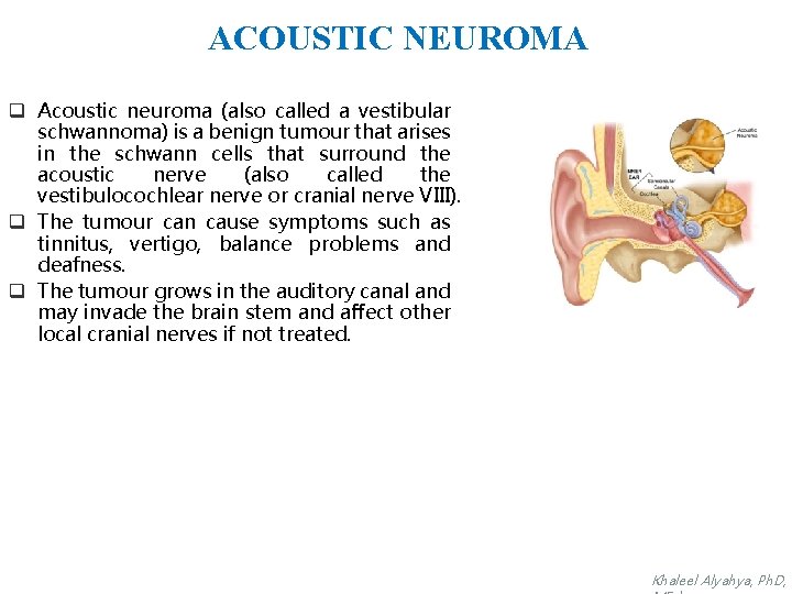ACOUSTIC NEUROMA q Acoustic neuroma (also called a vestibular schwannoma) is a benign tumour