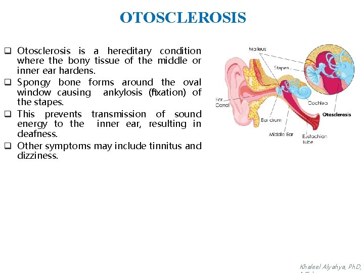 OTOSCLEROSIS q Otosclerosis is a hereditary condition where the bony tissue of the middle