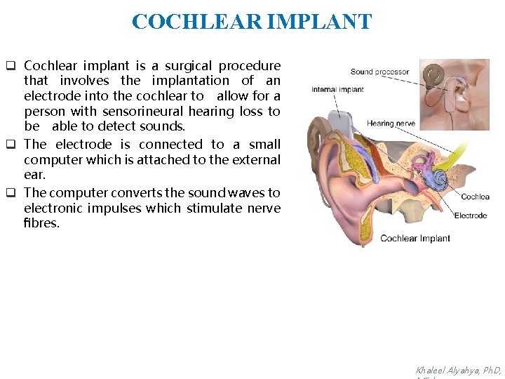 COCHLEAR IMPLANT q Cochlear implant is a surgical procedure that involves the implantation of
