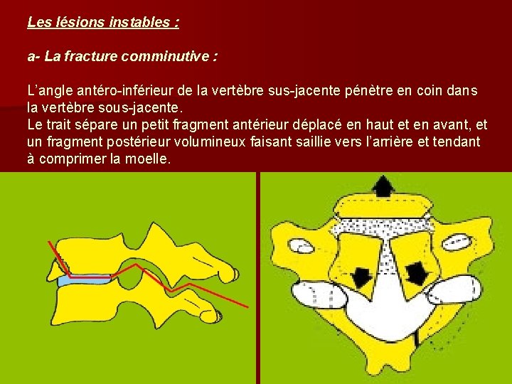 Les lésions instables : a- La fracture comminutive : L’angle antéro-inférieur de la vertèbre Les lésions instables : a- La fracture comminutive : L’angle antéro-inférieur de la vertèbre