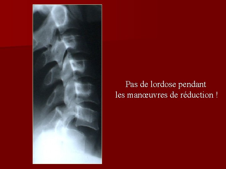 Pas de lordose pendant les manœuvres de réduction ! Pas de lordose pendant les manœuvres de réduction !