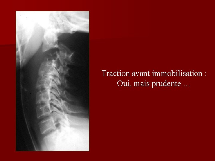 Traction avant immobilisation : Oui, mais prudente … Traction avant immobilisation : Oui, mais prudente …