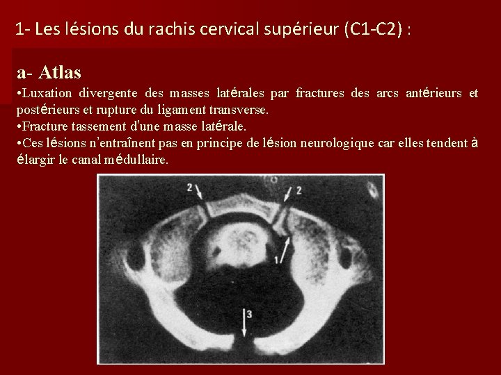 1 - Les lésions du rachis cervical supérieur (C 1 -C 2) : a- 1 - Les lésions du rachis cervical supérieur (C 1 -C 2) : a-