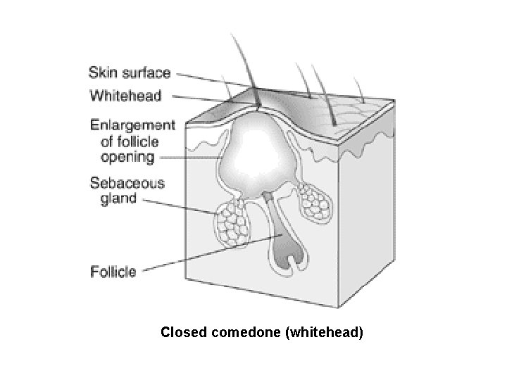 Closed comedone (whitehead) Closed comedone (whitehead)