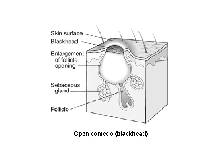 Open comedo (blackhead) Open comedo (blackhead)