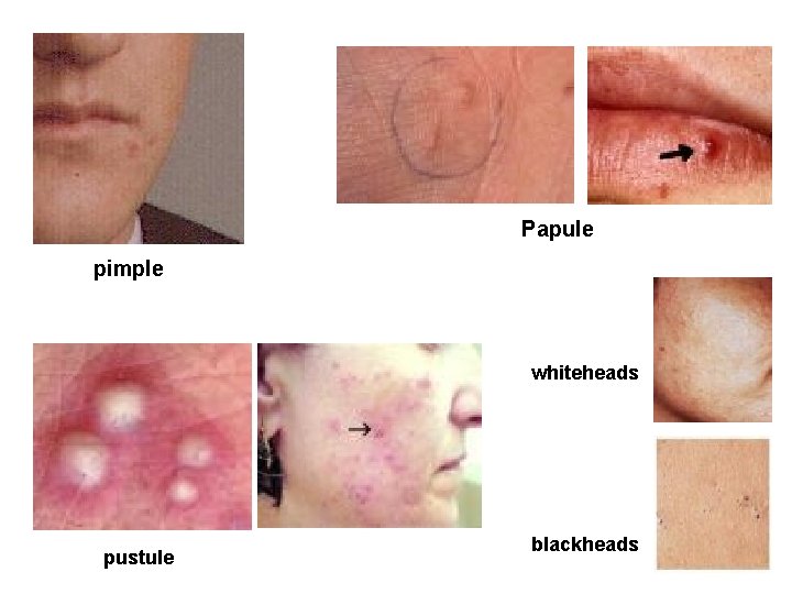 Papule pimple whiteheads pustule blackheads Papule pimple whiteheads pustule blackheads