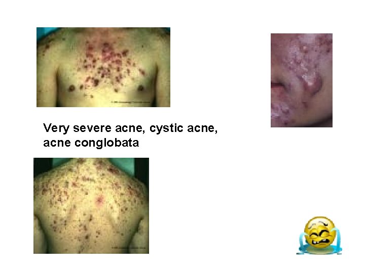 Very severe acne, cystic acne, acne conglobata Very severe acne, cystic acne, acne conglobata