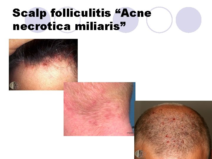 Scalp folliculitis “Acne necrotica miliaris” Scalp folliculitis “Acne necrotica miliaris”