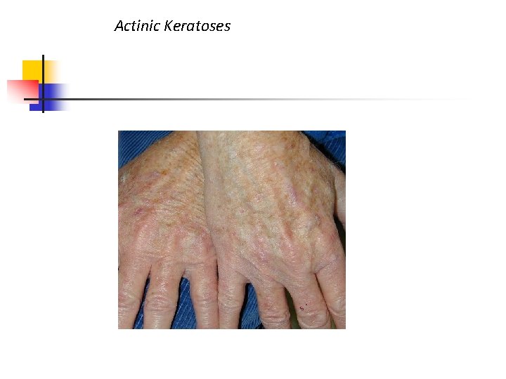 Actinic Keratoses 