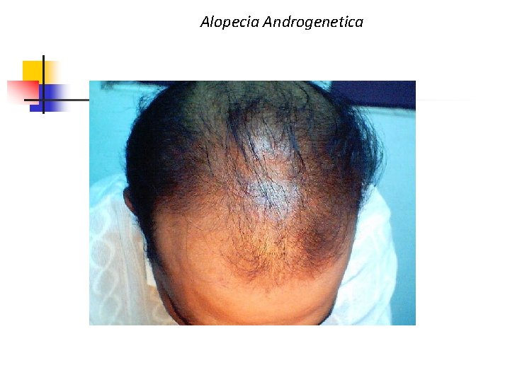 Alopecia Androgenetica 