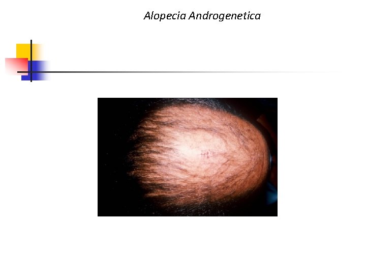 Alopecia Androgenetica 