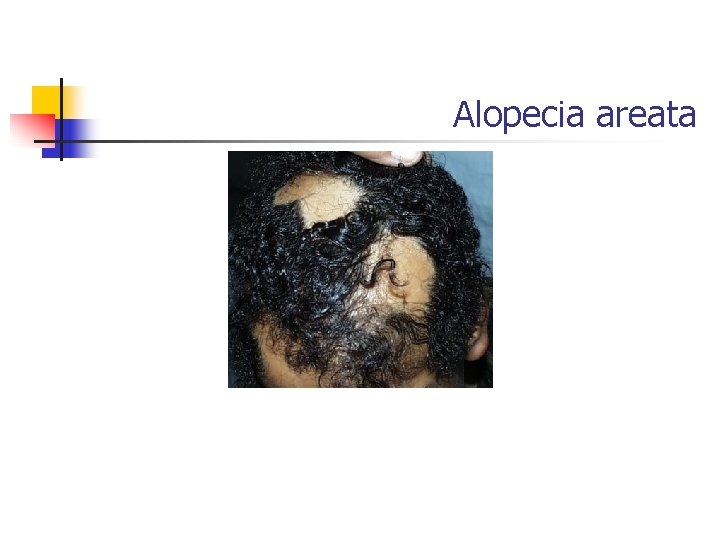 Alopecia areata 