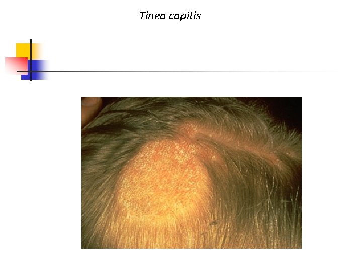 Tinea capitis 