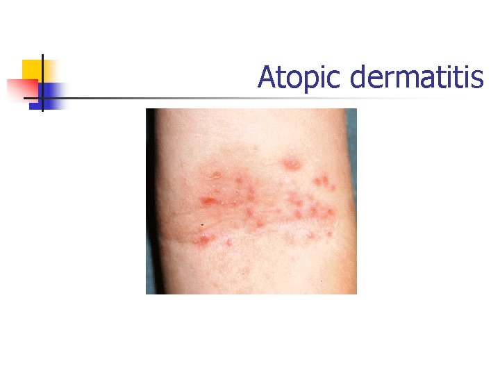 Atopic dermatitis 