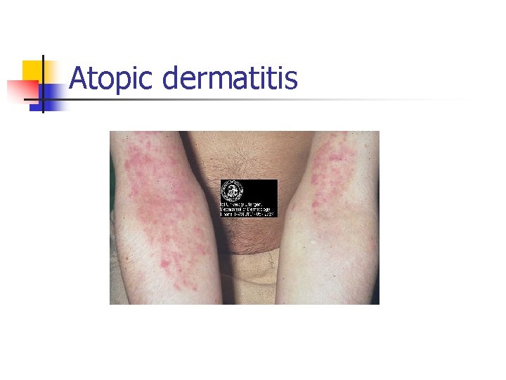 Atopic dermatitis 