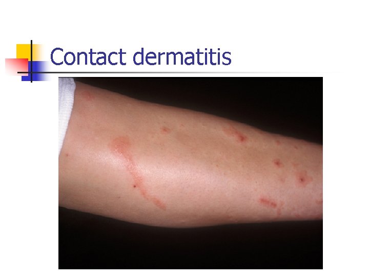 Contact dermatitis 