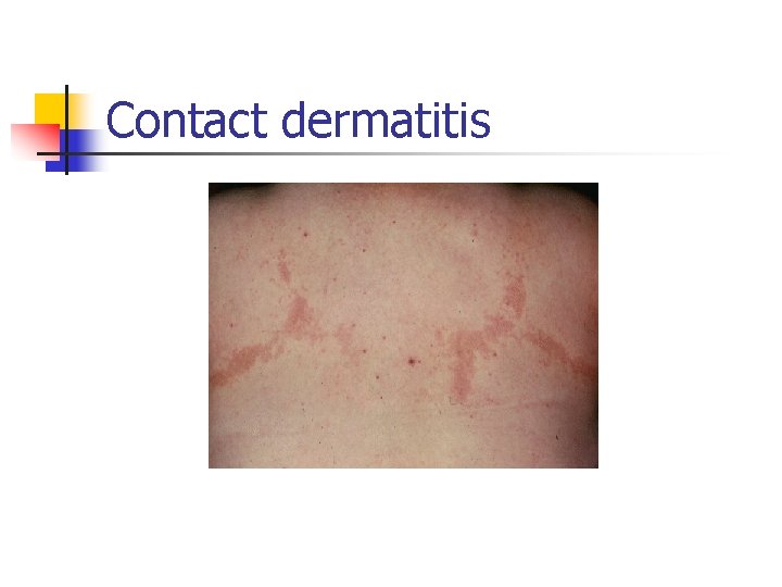 Contact dermatitis 