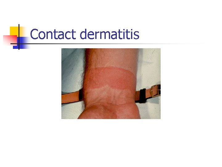 Contact dermatitis 