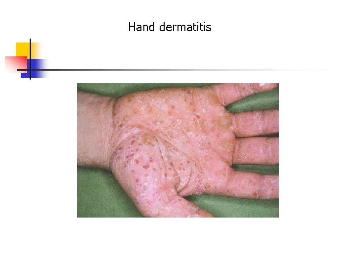 Hand dermatitis 