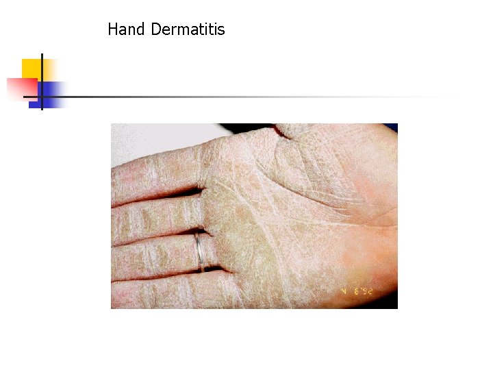 Hand Dermatitis 