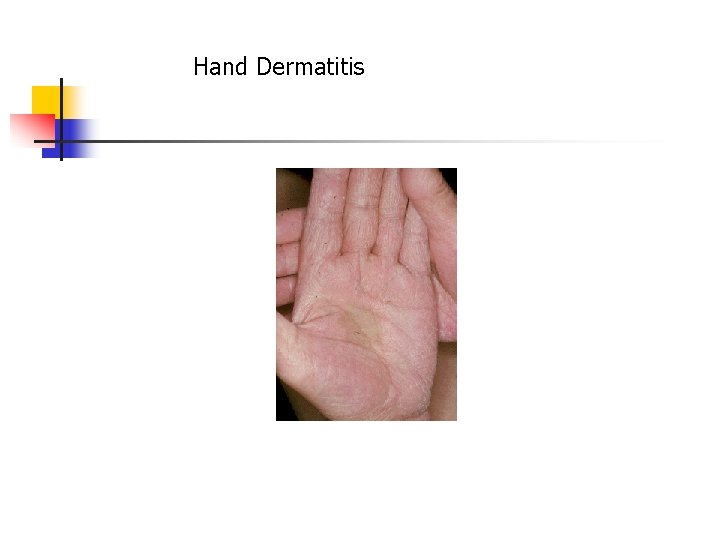 Hand Dermatitis 
