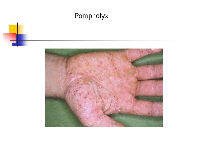 Pompholyx 