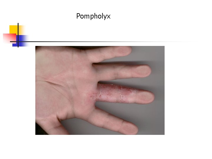 Pompholyx 