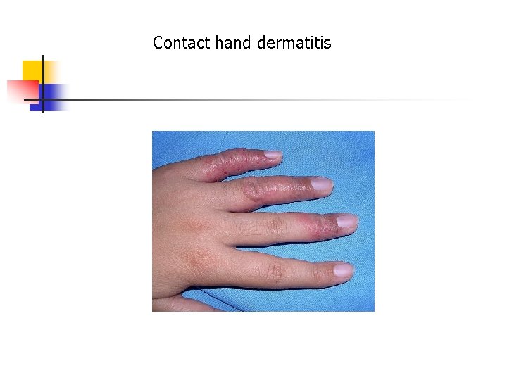 Contact hand dermatitis 