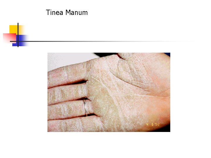 Tinea Manum 