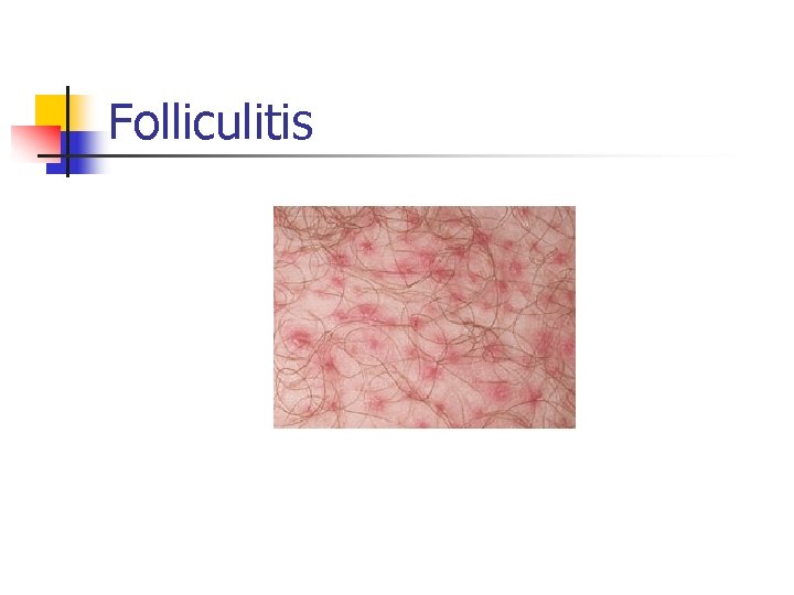 Folliculitis 