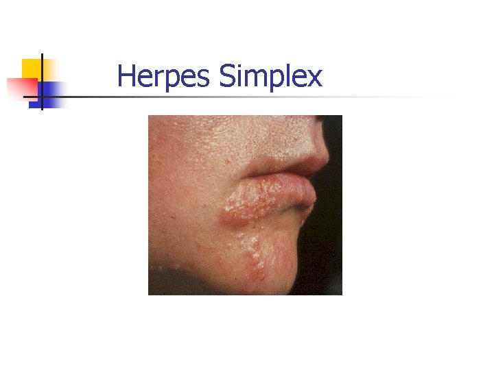 Herpes Simplex 