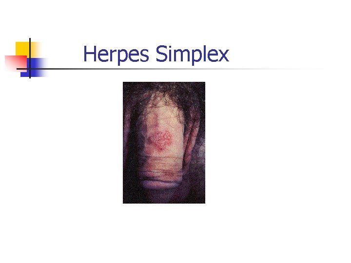 Herpes Simplex 