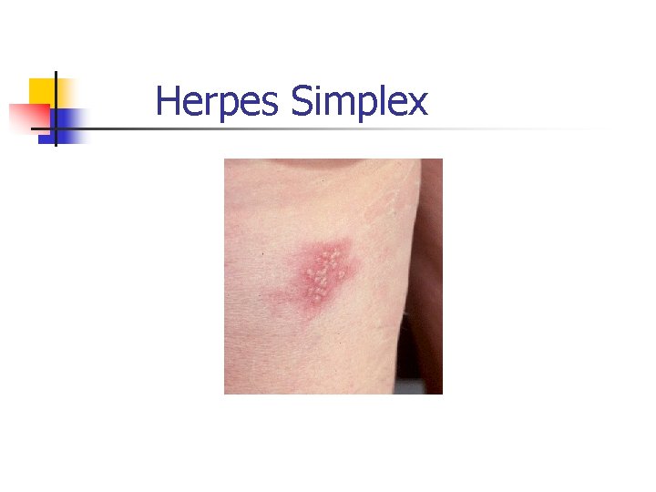 Herpes Simplex 