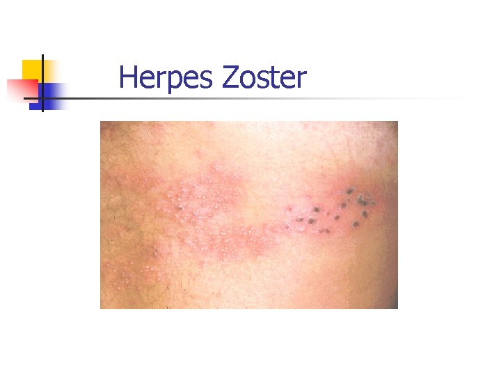 Herpes Zoster 