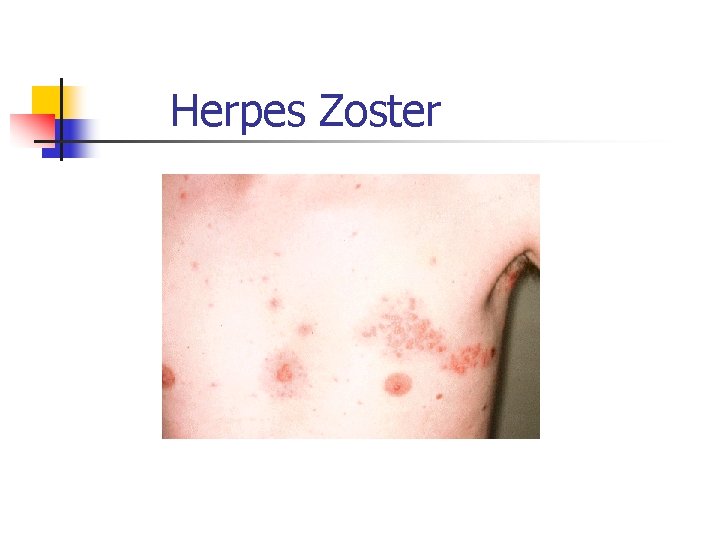 Herpes Zoster 