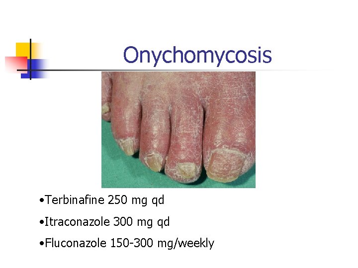 Onychomycosis • Terbinafine 250 mg qd • Itraconazole 300 mg qd • Fluconazole 150