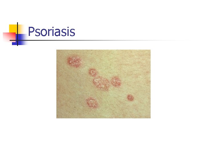 Psoriasis 