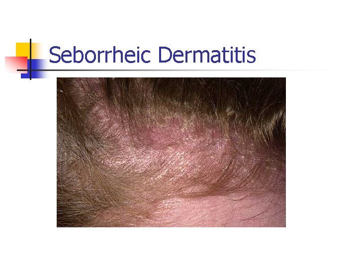 Seborrheic Dermatitis 
