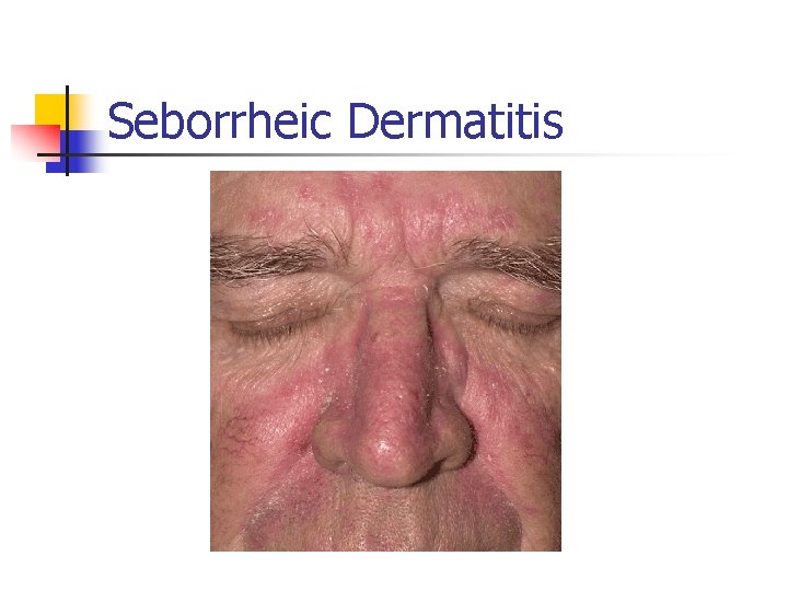 Seborrheic Dermatitis 