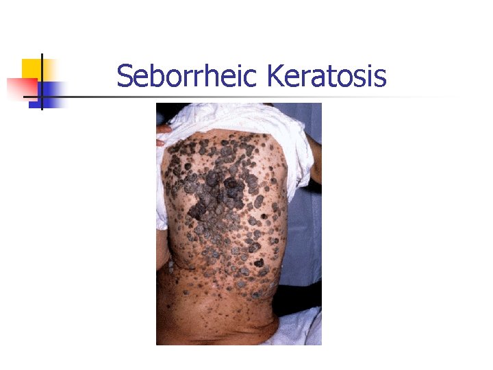 Seborrheic Keratosis 